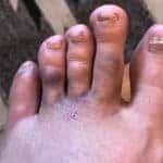 Kens broken toe June 2018